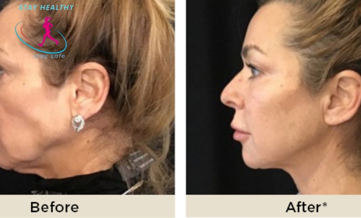 renuvion skin tightening