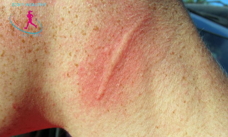 What is dermatographic urticaria?
