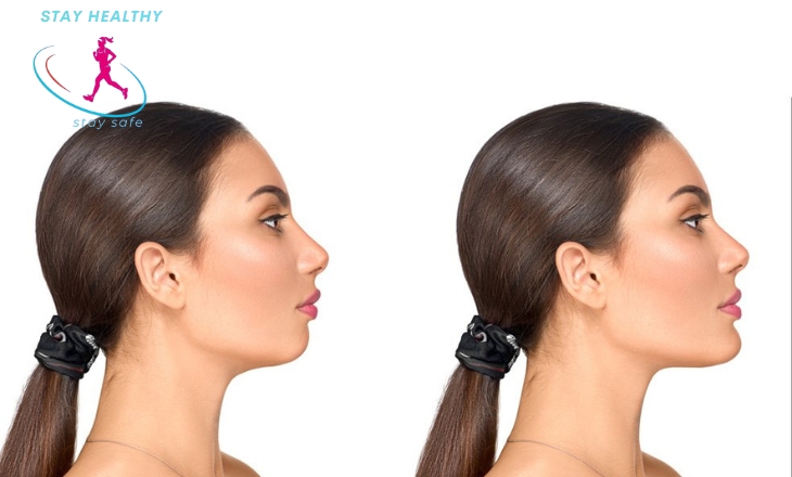 chin liposuction cost