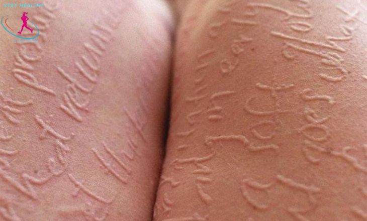 how long does dermatographia last

