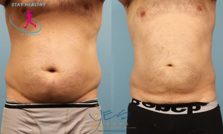 liposuction cost